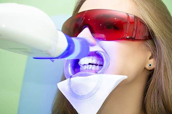 Laser teeth whitening treatments Berkshire