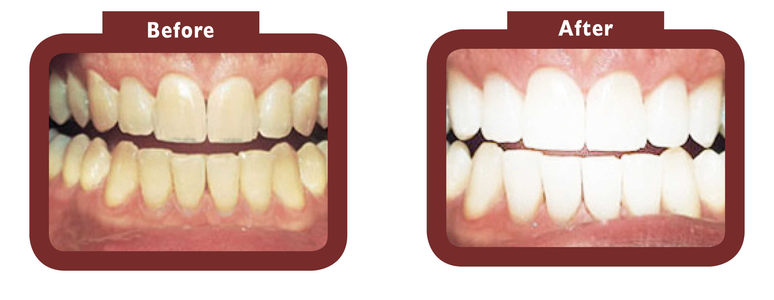 before and after teeth whitening - LA TEETH Berkshire