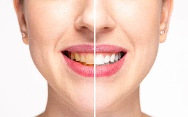 Teeth Whitening Milton Keynes Berkshire