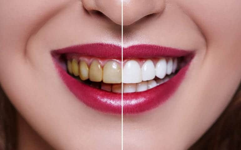 Teeth Whitening Ascot Windsor Berkshire